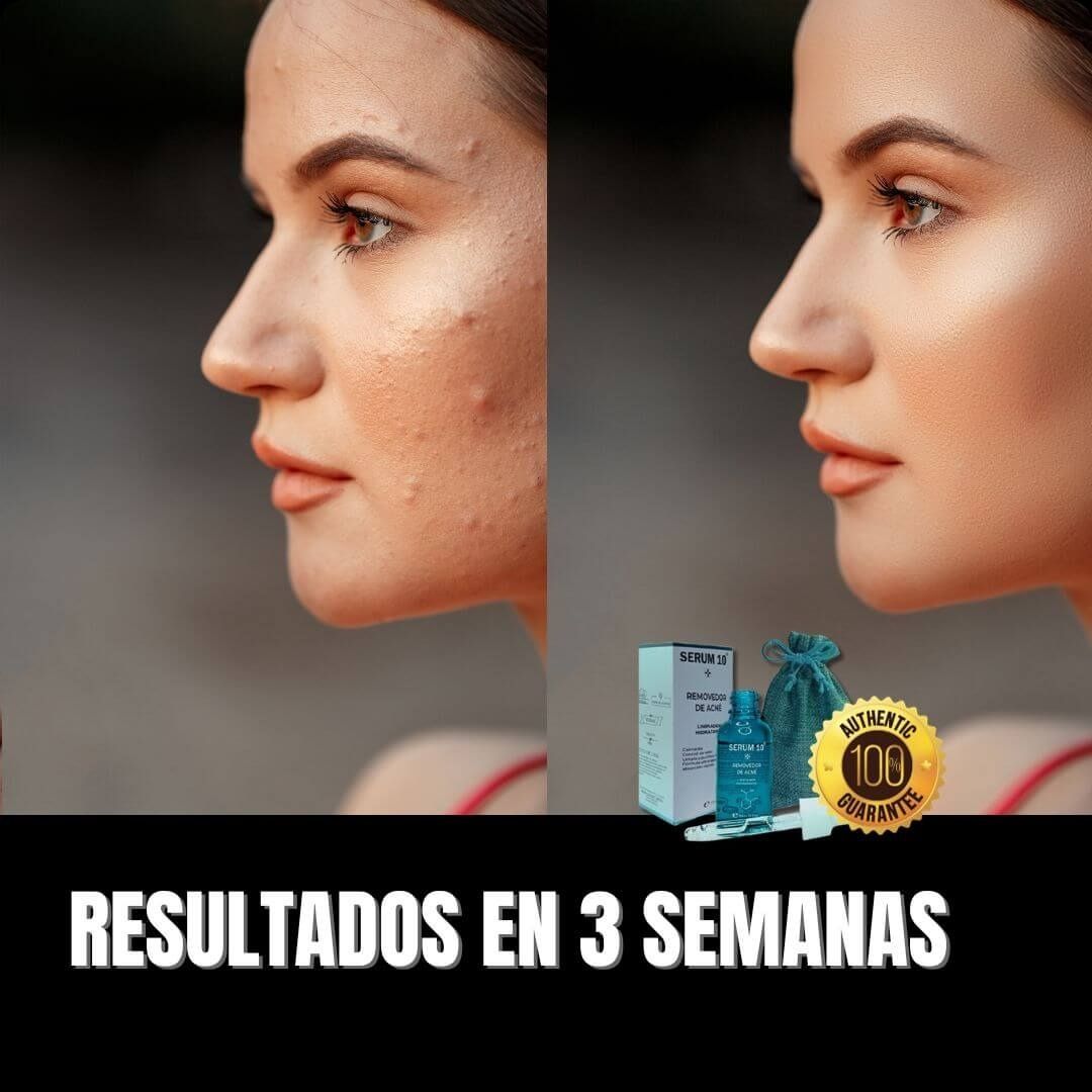 SERUM 10 ANTIACNÉ -🎁  PAGA 1 Y LLEVA 2